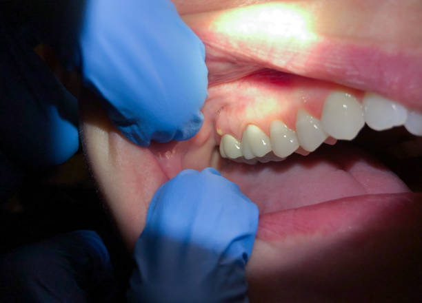 Best Emergency Treatment for Oral Infections in Hart, TX
