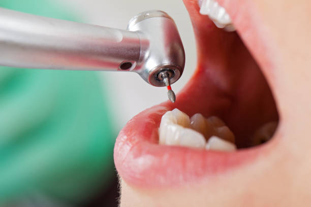 Best Knocked-Out Tooth (Avulsed Tooth) Treatment in Hart, TX